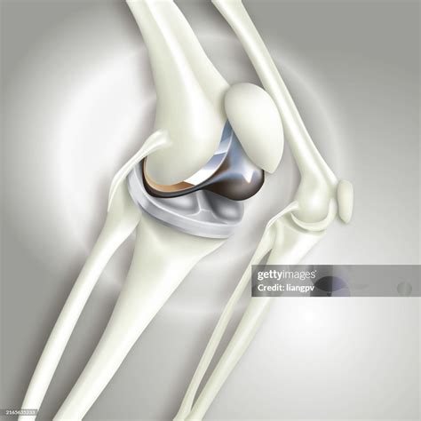 Knee Arthroplasty High-Res Vector Graphic - Getty Images