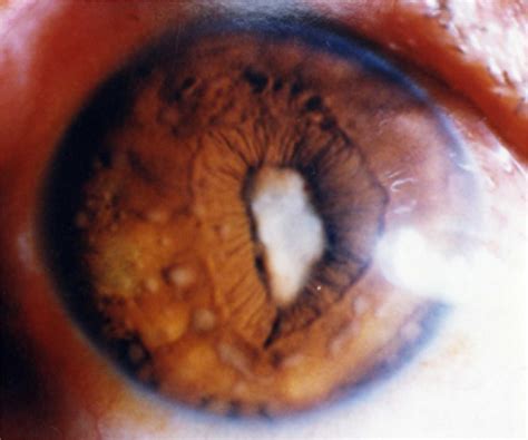 Clinical Characteristics of Vogt-Koyanagi-Harada Syndrome in Chinese ...