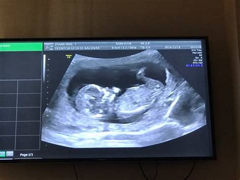 怀孕13周胎儿图性别,怀孕13周胎儿图片 - 伤感说说吧