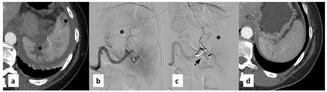 Medium- and Long-Term Evaluation of Splenic Arterial Embolization: A ...