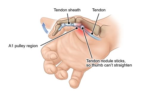 Trigger Finger Pathway: Your journey with trigger finger
