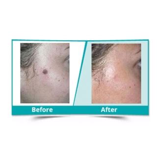 Warts, Mole and Skin Tag Removal in Delhi, Warts Treatment, Moles Removal