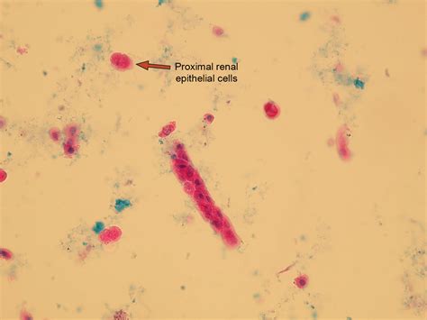Epithelial cells | Microscopic Analysis of Urine | Faculty of Medicine ...