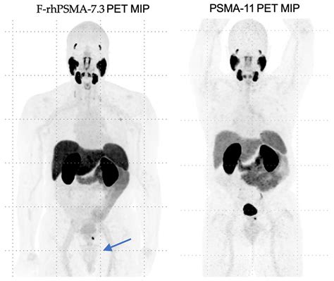 PSMA-Directed Theranostics in Prostate Cancer | MDPI