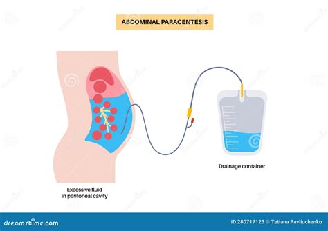 Image result for Paracentesis Procedure Kit