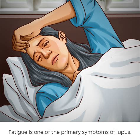 A Guide to Navigating Interactions with Lupus Patients - Newbies Guide ...