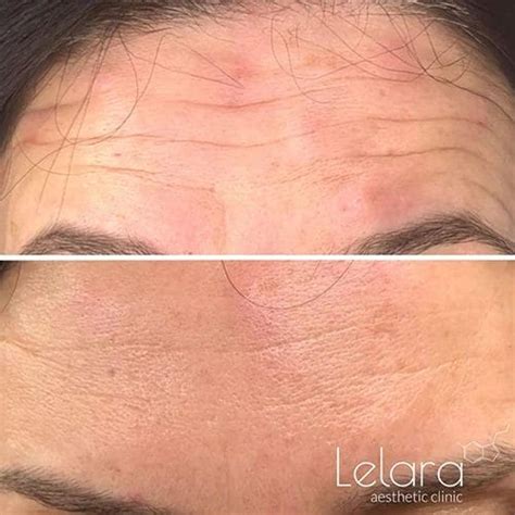 Image result for Botox Examples