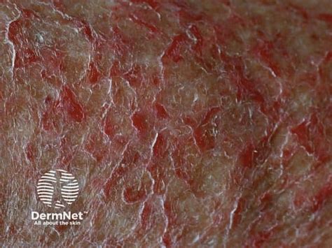 https://dermnetnz.org/assets/Uploads/dermatitis/eczema-craquele5.jpg