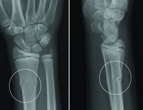 Buckle Fracture - Raleigh Hand Surgery — Joseph J. Schreiber, MD
