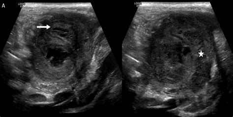 Image result for Perforated Appendix