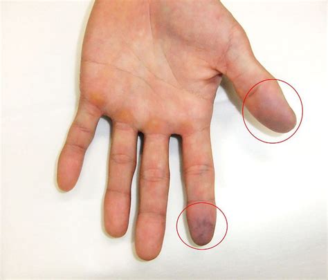 Finger Tips Bruising at Marcia George blog