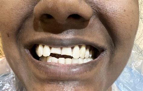 Cosmetic Dentistry - Edens dental and face hospital