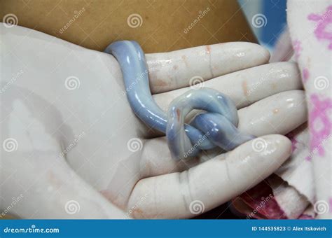 Umbilical Cord of New Born Baby Twisted into a Knot. Stock Image ...