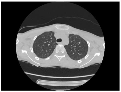 Clinical and Evolutive Features of Tuberculous Meningitis in an ...