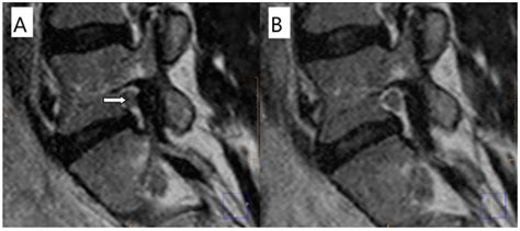 Associations between Patient Report of Pain and Intervertebral Foramina ...