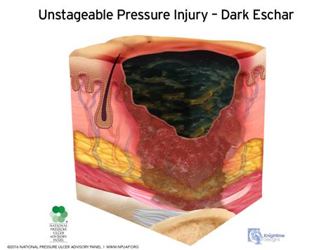 Unstageable Pressure Ulcer