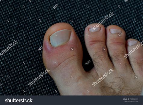 Toe Nail Bed Hurts