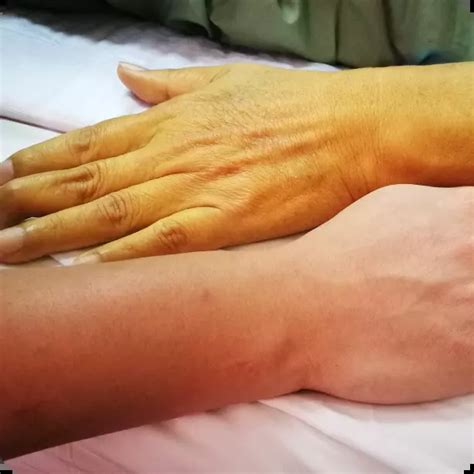 पीलिया के कारण: वह सब कुछ जो आपको जानना चाहिए