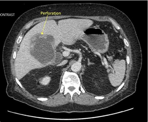 Perforated gallbladder : r/Radiology