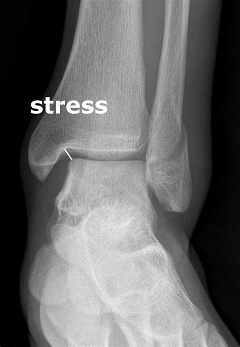 Cpt Code For Distal Fibula Fracture at Isabel Kleeman blog