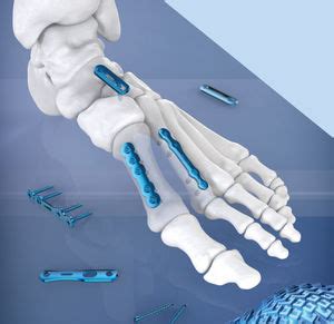 Compression Plate Ankle 的图像结果