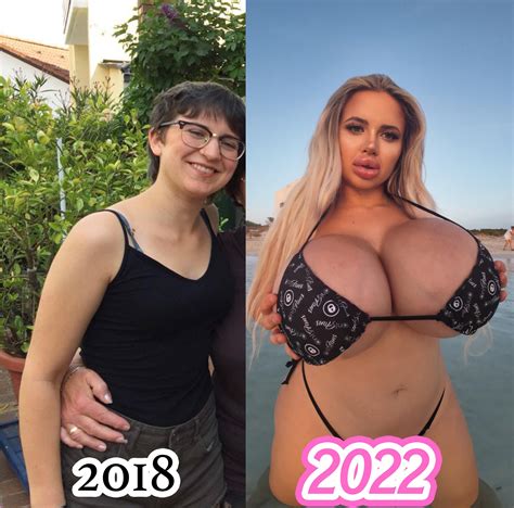 Beginning my bimbo journey. 375 CC implants (as big as she could fit) and also lip filler… Plans ...