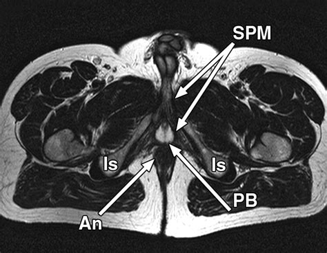 Perineum Pyramidal Protrusion