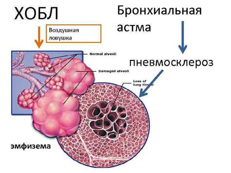 ACOS перекрестный синдром ХОБЛ и бронхиальной астмы
