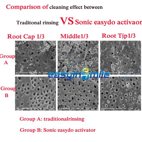 Buy endo sonic activator 60 soft tips Ultra irrigator for 3D endo root ...