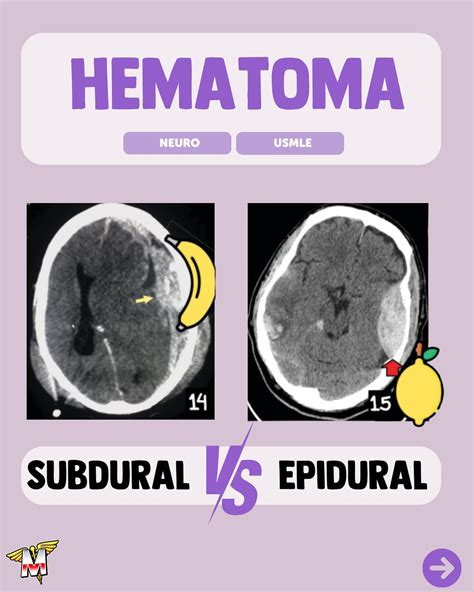 Hemorragia Epidural