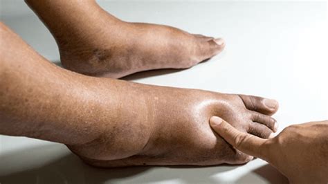 body swelling home remedy never ignore this in life anga sujan che home ...
