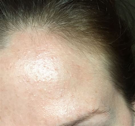 Tiny Red Bumps On Face Rash
