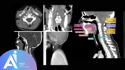 How to Read a Neck CT Scan | AI-PACS