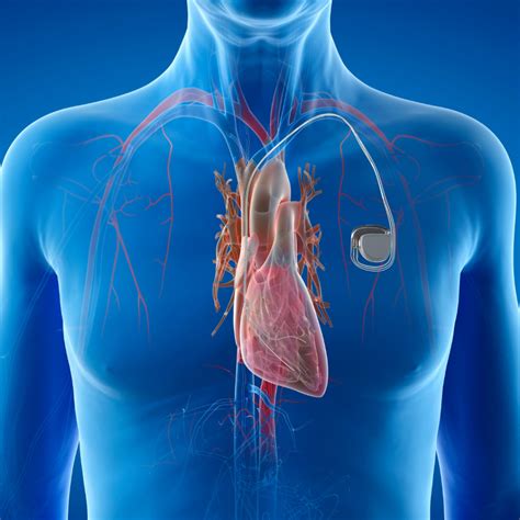 Insertion of a Pacemaker or Defibrillator Device | Monash Heart Private