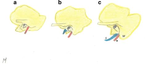 Image result for Temporal Bone Mastoid Process