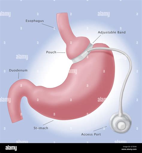 Gastric band operation hi-res stock photography and images - Alamy