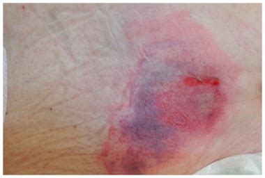 homeopathic treatment for Pressure ulcers or bedsores in homeopathy ...