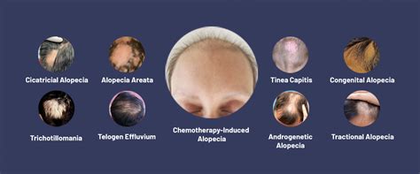 Types of Alopecia: Different Types of Male Pattern Baldness – Formen Health