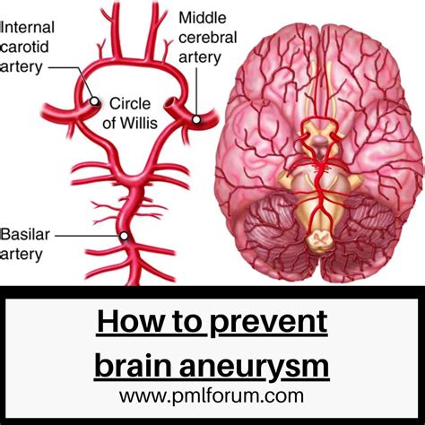 Proactive Brain Health: How to Prevent Aneurysms