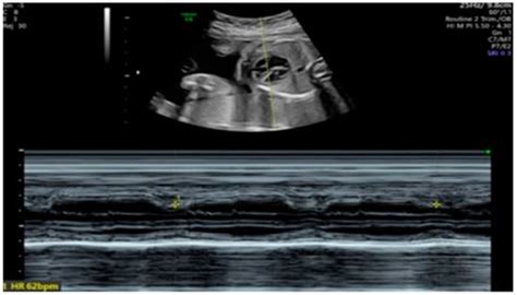 Improved Myocardial Function in Autoimmune-Mediated Fetal Complete ...