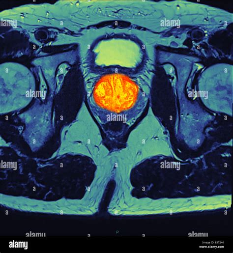 Prostate cancer mri hi-res stock photography and images - Alamy