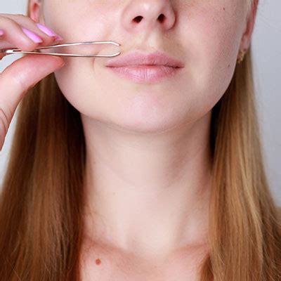 Hirsutism Treatment in Vijayawada | Facial Hair in Women Treatment ...