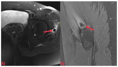 Hydroxyapatite Deposition Disease: A Comprehensive Review of ...
