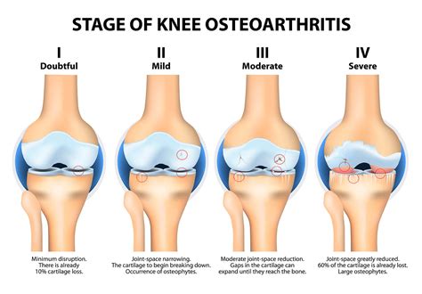 New Treatments for Osteoarthritis?