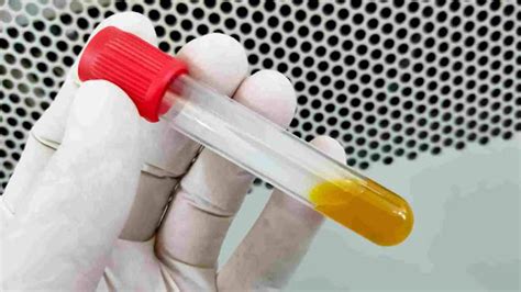 High Bilirubin Levels: Symptoms, Causes, and Effective Treatments