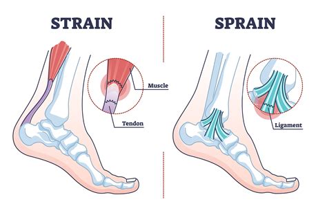 Sprains vs Strains - Therapia