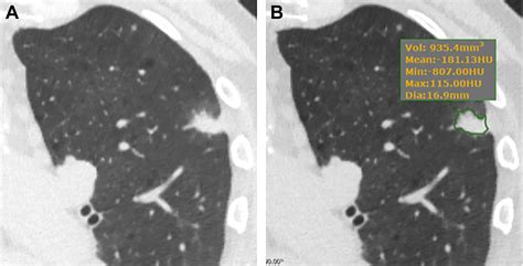 Imaging of Solid Pulmonary Nodules - Clinics in Chest Medicine