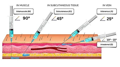Injection Types 的图像结果
