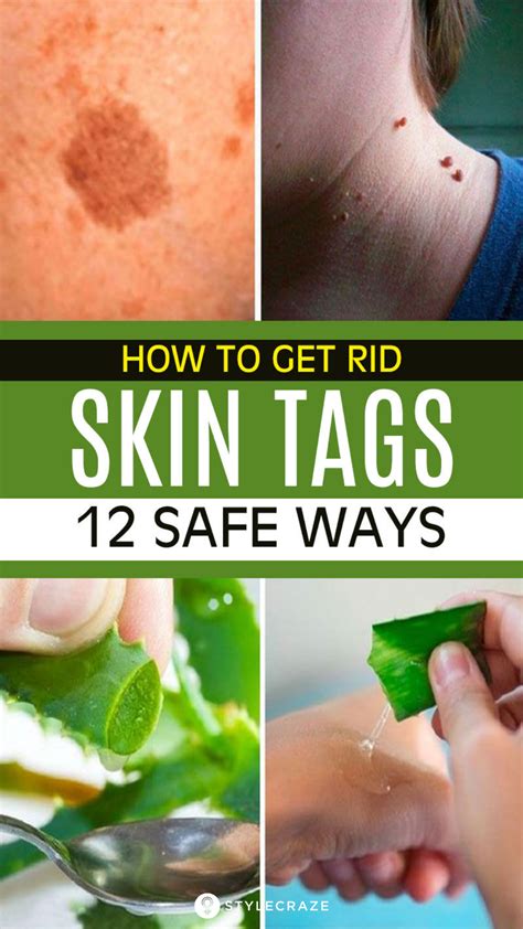 12 Home Remedies To Remove Skin Tags Naturally | Natural health ...
