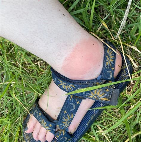 Can Yellow Jacket Stings Cause Cellulitis at Henry Christie blog